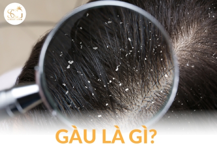 Gàu là gì? Nguyên nhân, cách trị gàu hiệu quả và bí quyết chăm sóc da đầu khỏe mạnh