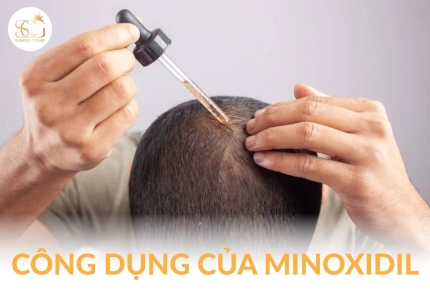 Minoxidil: Công dụng, cơ chế hoạt động và ứng dụng trong chăm sóc tóc