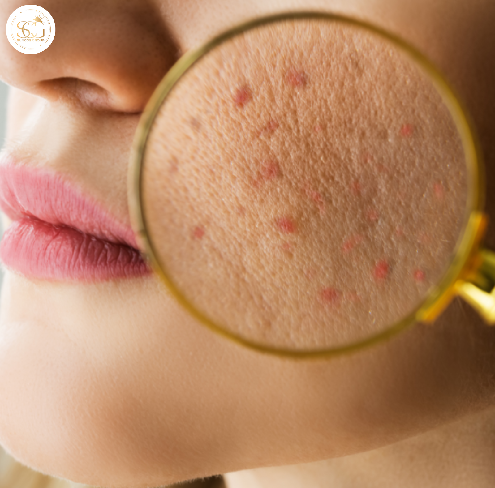 dấu hiệu da bị kích ứng mỹ phẩm