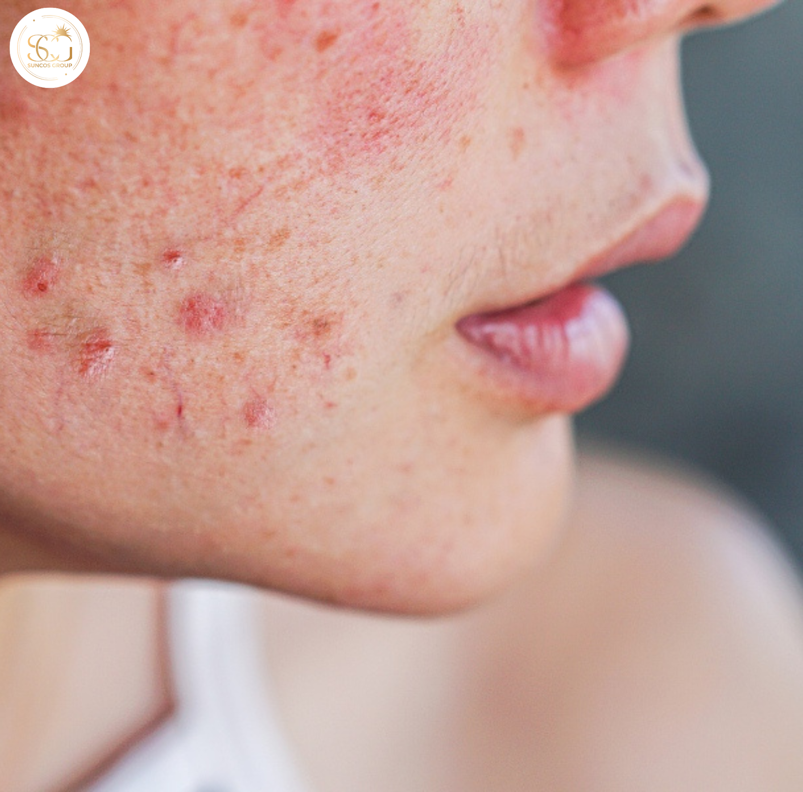 kích ứng mỹ phẩm là gì