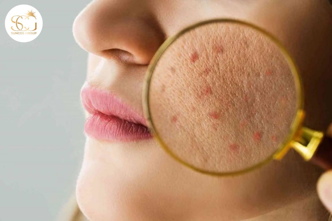 Emulsion có phù hợp với mọi loại da không