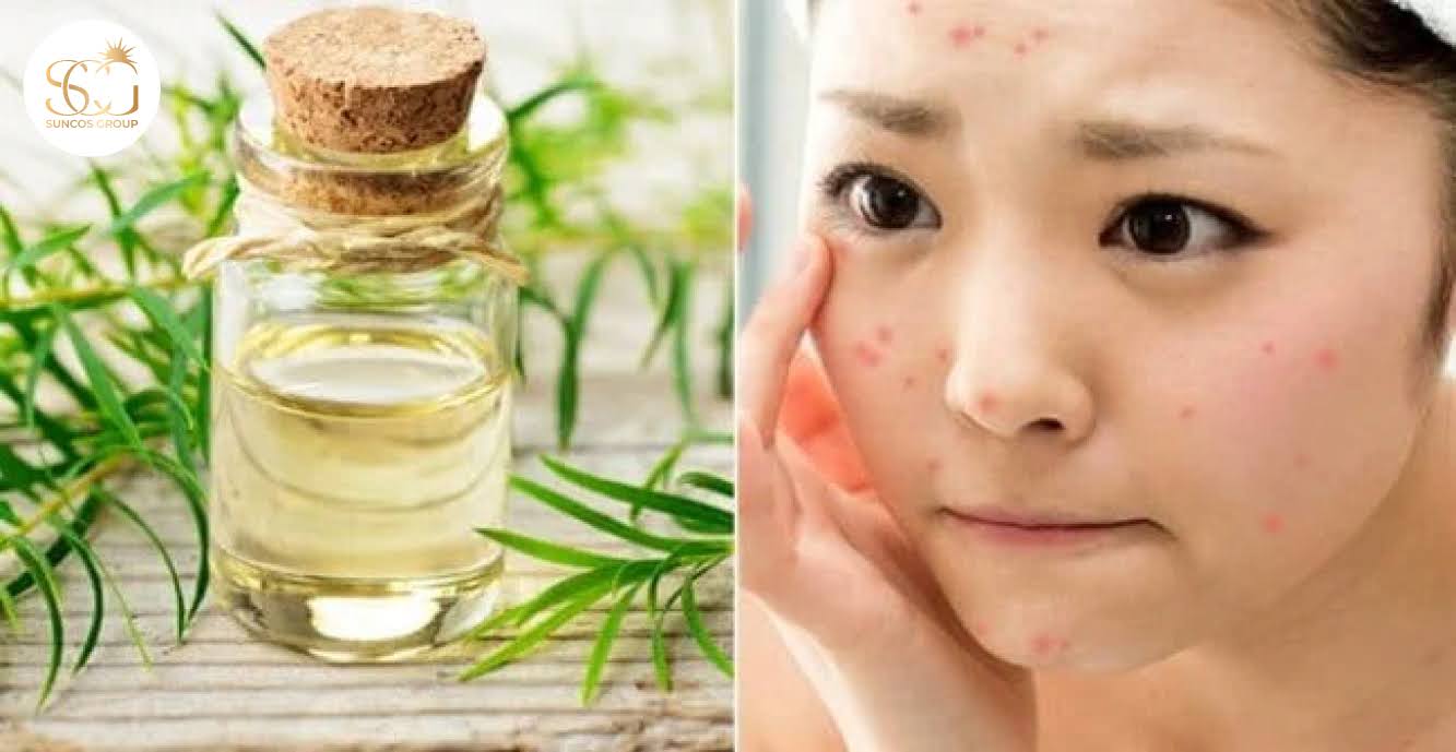 tác dụng của tinh dầu tràm trà